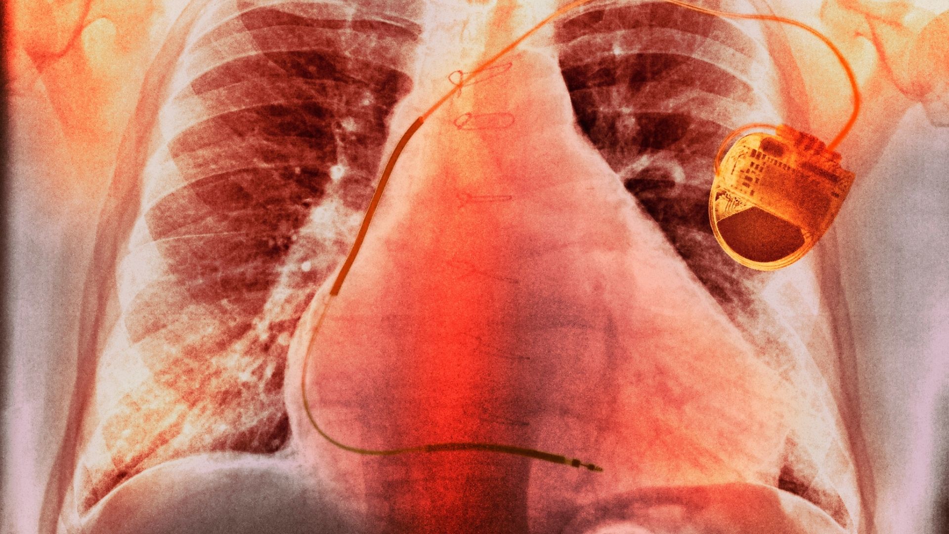 אלעד לאור: מחלת ריאות חסימתית כרונית (COPD)